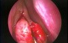 Concha Bullosa Resection