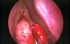Concha Bullosa Resection