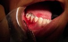 Part 2/8: Root Coverage Surgery - Mandibular Premolar - Mid Surgery