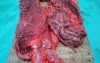 Multiple Rectal Ulcers (82 of 110)