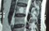 Hemangioma