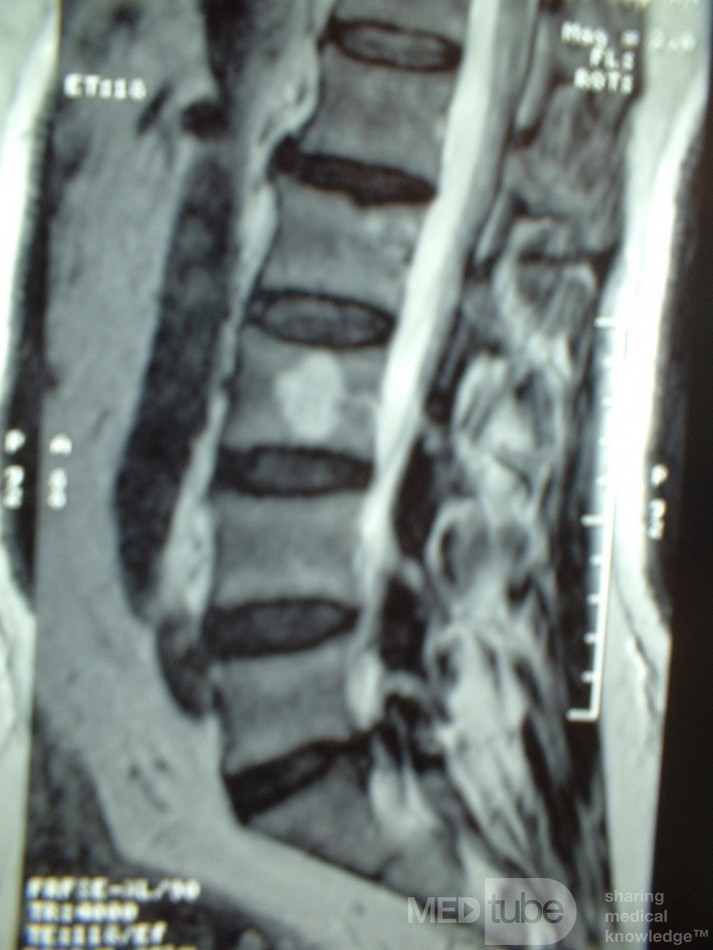 Hemangioma