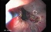 Severe Bleeding of the Upper Digestive System After Two Days of Band Ligation - Attempt of Coagulation without Contact