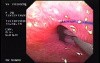 Flexible Endoscopic Suturing - Suctioning