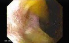 Choledocoduodenostomy (2 of 3)