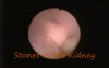 ADAM simulator- nefroscopy