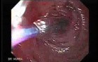 Gastric Cicatrization With Pylorus Stenosis (5 of 23)