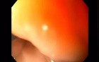 Endoscopic Balloon Removal (6 of 9)