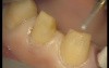 Upper Arch Teeth Preparation And Provisional Crowns (2/5)