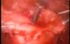 Cystic Uterine Myoma - Laparoscopic Treatment