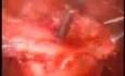 Cystic Uterine Myoma - Laparoscopic Treatment