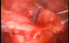 Cystic Uterine Myoma - Laparoscopic Treatment