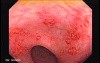 Endoscopic View Of Diverticulitis Of The Sigmoid (4 of 4)