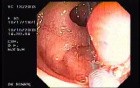 Tubulo - Villous Adenoma - Endoscopy (11 of 28)