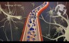 Damage from Tetralogy of Fallot Defects