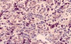 Gastric Cancer (12 of 15)