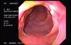 Crohn´s Disease (1 of 28)