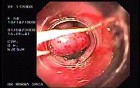 Banding of Esophageal Varices - Two Ligated Varices