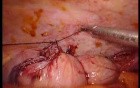 Colonic Perforation With Peritonitis - Laparoscopy (11 of 46)