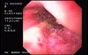 Hemorrhagic Esophagitis Due To Alcoholism - Patchy Mucosal Erythema