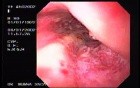 Hemorrhagic Esophagitis Due To Alcoholism - Patchy Mucosal Erythema