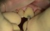 How To Deal With Apical Fenestration While Immediate Implantation