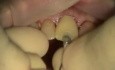 How To Deal With Apical Fenestration While Immediate Implantation