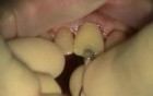 How To Deal With Apical Fenestration While Immediate Implantation