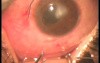 Fugo Plasma Blade Vs Femtosecond Laser as Technologies of Filtration Surgery