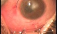 Fugo Plasma Blade Vs Femtosecond Laser as Technologies of Filtration Surgery