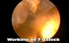 Greenlight HPS - Resection Of The Medial Lobe