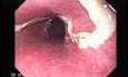 Gastric Varices - Endoscopic Ablation With Cyanoacrylate Glue (16 of 18)