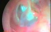 ModifIIed Radical Mastoidectomy 7 Year post operative Video