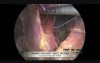 Laparoscopic Nissen Fundoplication for GERD