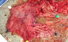 Small Gastric Adenocarcinoma of the Diffuse Ring Cell (9 of 19)