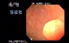 Polypectomy - diathermy snare
