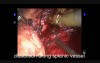Robotic-Assisted Laparoscopic Spleen-Preserving Distal Pancreatectomy