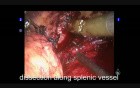 Robotic-Assisted Laparoscopic Spleen-Preserving Distal Pancreatectomy