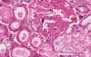Amyloidosis - Kidney - Histopathology