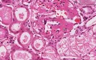 Amyloidosis - Kidney - Histopathology