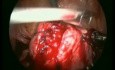 Excision of Leiomyomas