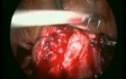 Excision of Leiomyomas