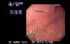 Percutaneous Endoscopic Gastrostomy (1 of 3)