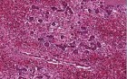 Viral hepatitis with fulminant necrosis