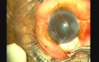 Trabeculeclectomy With MMC
