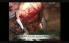Esophageal Leiomyoma