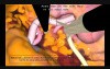 LAP-X simulator for minimal invasive surgery: Kidney clip and cut