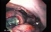 Multiple Irregular and Large Ulcers - Biopsy nr 3