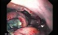 Multiple Irregular and Large Ulcers - Biopsy nr 3