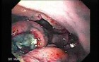 Multiple Irregular and Large Ulcers - Biopsy nr 3